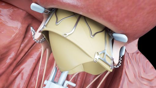 Orgoglio torinese: alle Molinette impiantata per la prima volta al mondo una protesi al cuore "speciale" Orgoglio torinese: alle Molinette impiantata per la prima volta al mondo una protesi al cuore "speciale"