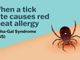 Se una zecca rende allergici a carne e latticini, cos'è la sindrome alfa-gal Se una zecca rende allergici a carne e latticini, cos'è la sindrome alfa-gal