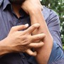 Studio Novartis, l’orticaria cronica spontanea costa 4.200 euro l’anno a paziente Studio Novartis, l’orticaria cronica spontanea costa 4.200 euro l’anno a paziente