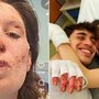 Crans-Montana, oggi dimessi due ragazzi. Eleonora Palmieri mostra le ustioni sui social Crans-Montana, oggi dimessi due ragazzi. Eleonora Palmieri mostra le ustioni sui social