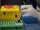 Alzheimer, via libera a test del sangue per diagnosi: cosa significa