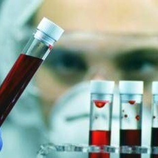 Giornata patologie eosinofile, ematologa Iurlo 'fino a 5 anni per diagnosi' Giornata patologie eosinofile, ematologa Iurlo 'fino a 5 anni per diagnosi'