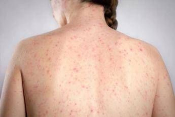 Morbillo, l'allarme dell'infettivologo Andreoni: "Casi in crescita, ricoveri frequenti negli adulti" Morbillo, l'allarme dell'infettivologo Andreoni: "Casi in crescita, ricoveri frequenti negli adulti"