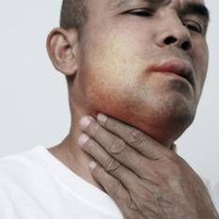 Angioedema ereditario, ok Ue a prima terapia preventiva mirata all'Rna Angioedema ereditario, ok Ue a prima terapia preventiva mirata all'Rna