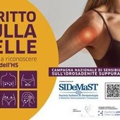 Idrosadenite suppurativa, al via campagna di sensibilizzazione 'Scritto sulla pelle' Idrosadenite suppurativa, al via campagna di sensibilizzazione 'Scritto sulla pelle'
