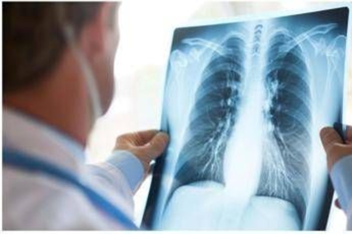 Tumore al polmone a piccole cellule in stadio esteso, ok Aifa a primo anti Pd-1 in prima linea