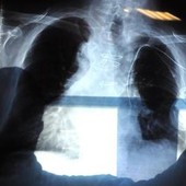 Bpco, pneumologa Foschino Barbaro: "Nella donna sintomi diversi, attenzione alle giovani"