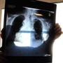 Sirm: "Ai strumento anti liste d'attesa, 50% esami imaging per over70 non necessario"