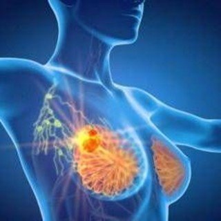Tumore al seno triplo negativo, speranze da anticorpo farmaco-coniugato
