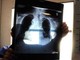 Tumori, in carcinoma polmonare risultati positivi da combinazione in prima linea