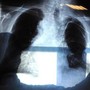 Bpco, pazienti e Cittadinanzattiva: "Aggiornamento Nota 99 favorisce cure eque"