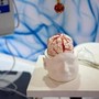 Dai gliomi al Parkinson, così l’intelligenza artificiale aiuta la Neurochirurgia