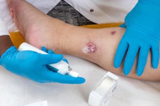 Idrosadenite suppurativa, le iniziative di Ucb per migliorare diagnosi e cura