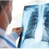 Tumore al polmone a piccole cellule in stadio esteso, ok Aifa a primo anti Pd-1 in prima linea