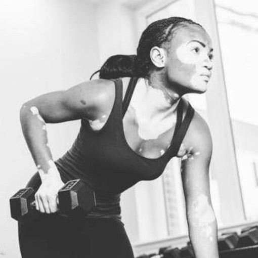 Vitiligine, &quot;così la terapia della luce aiuta il farmaco&quot;